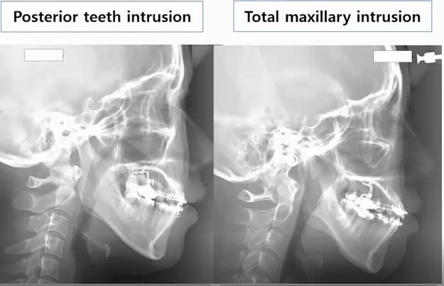 Đánh lún răng hàm lớn hàm trên và đánh lún toàn bộ hàm trên